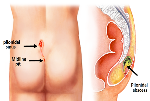 Pilonidal Sinus